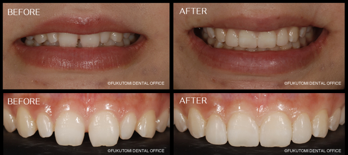 矮小歯ダイレクトボンディング