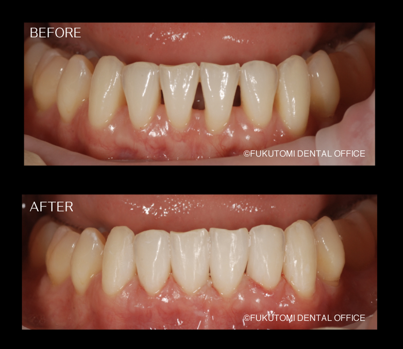 ブラックトライアングルをダイレクトボンディング